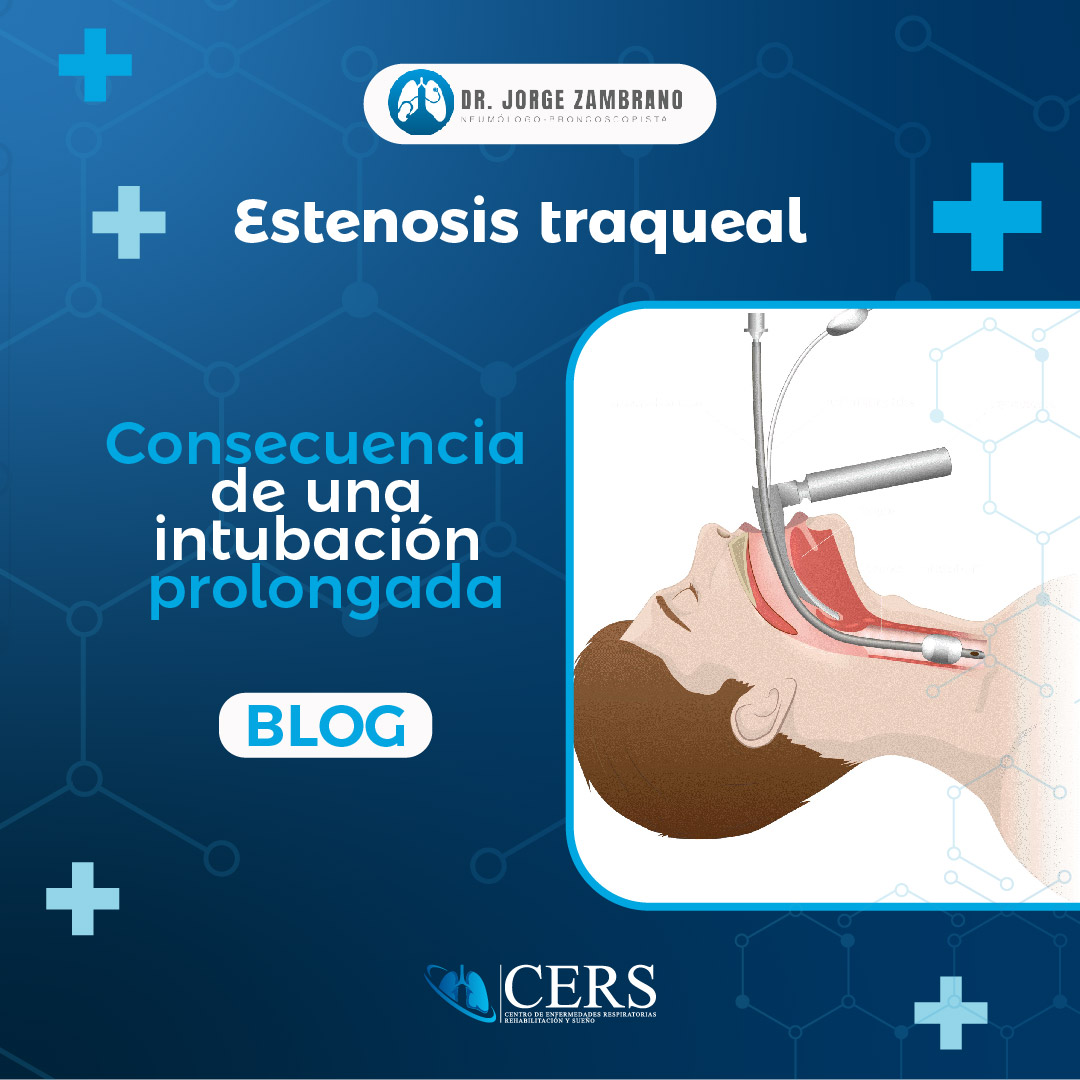 Estenosis traqueal