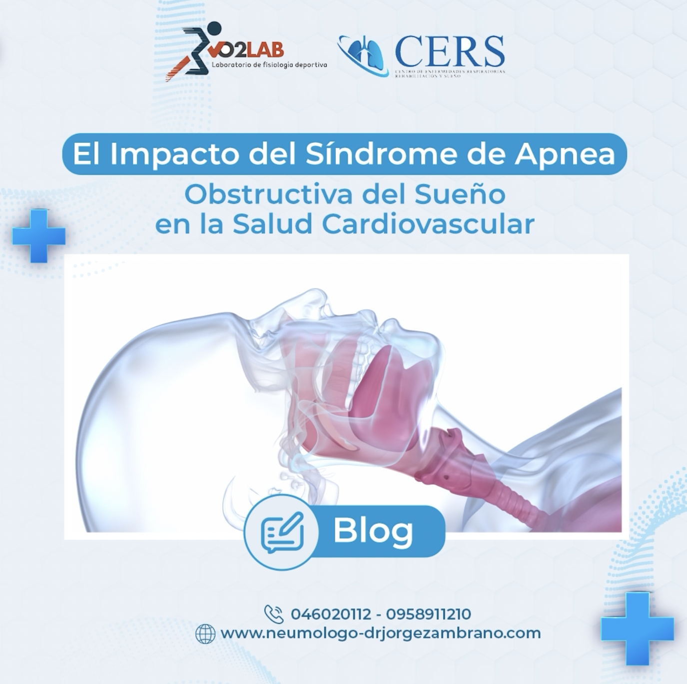 apnea obstructiva